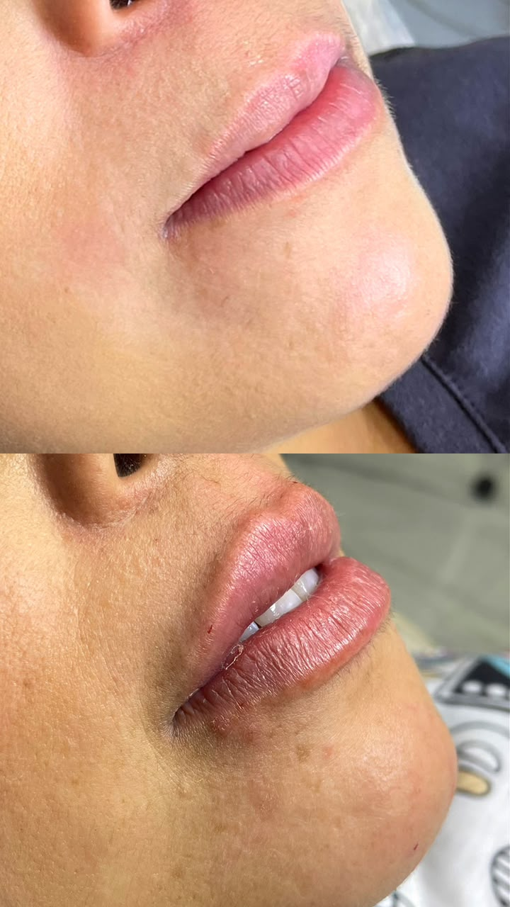 Preenchimento Labial - Antes e Depois